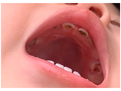 河北惟德口腔涂氟流程簡單，孩子配合度拉滿