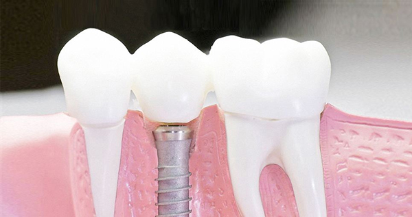 在承德口腔種植牙齒需要多少錢？惟德口腔一一為您道來